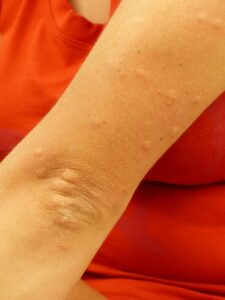 Lekarz alergolog – dokładne testy alergiczne