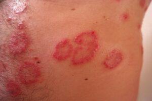 Testy uczuleniowe testy alergiczne na metale