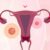 Endometrioza: Przyczyny, objawy i metody leczenia tej choroby